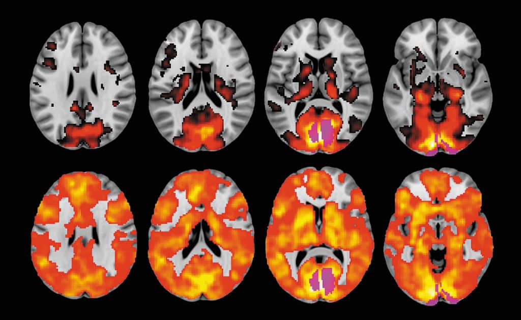 LSD Brain Scan